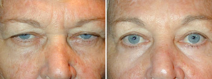 Before and After Lower Laser Eyelid Surgery with Lower Eyelid Laser Skin Resurfacing
