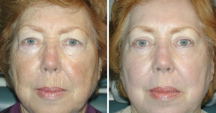 Before and After Upper and Lower Laser Eyelid Surgery with Full Face Laser Skin Resurfacing