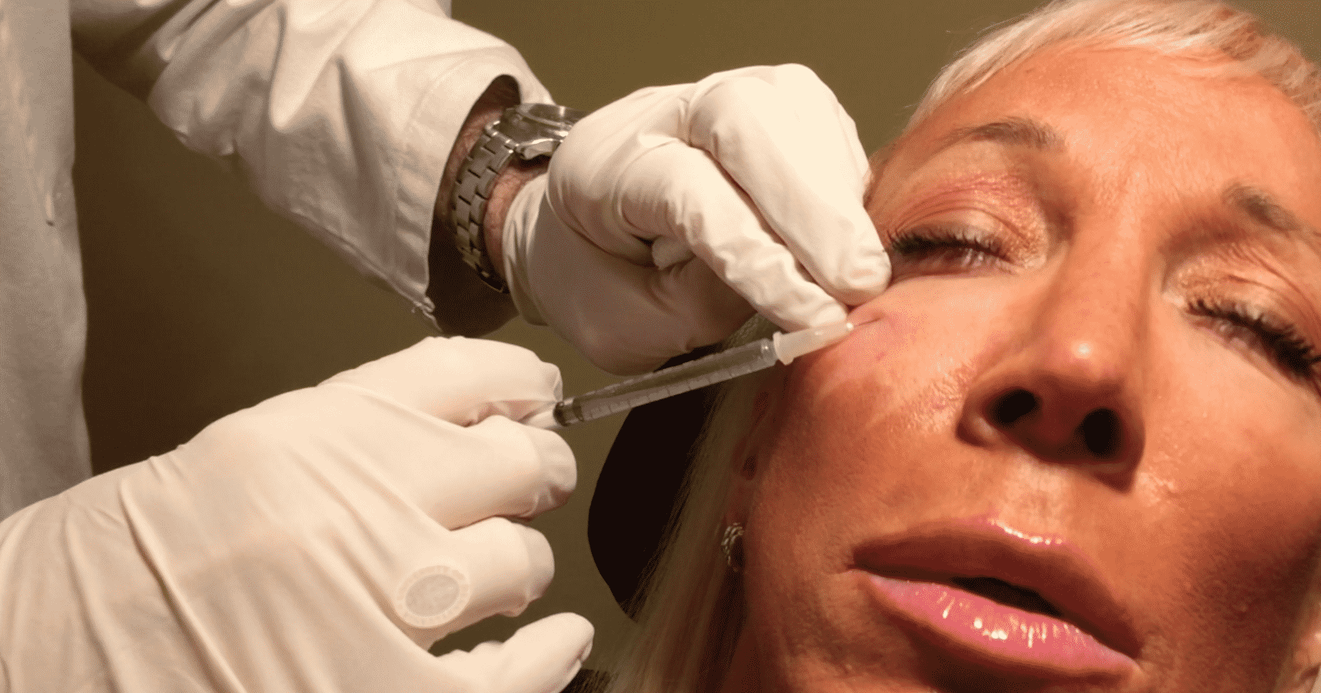 Hyaluronic Acid fillers placed under the eye