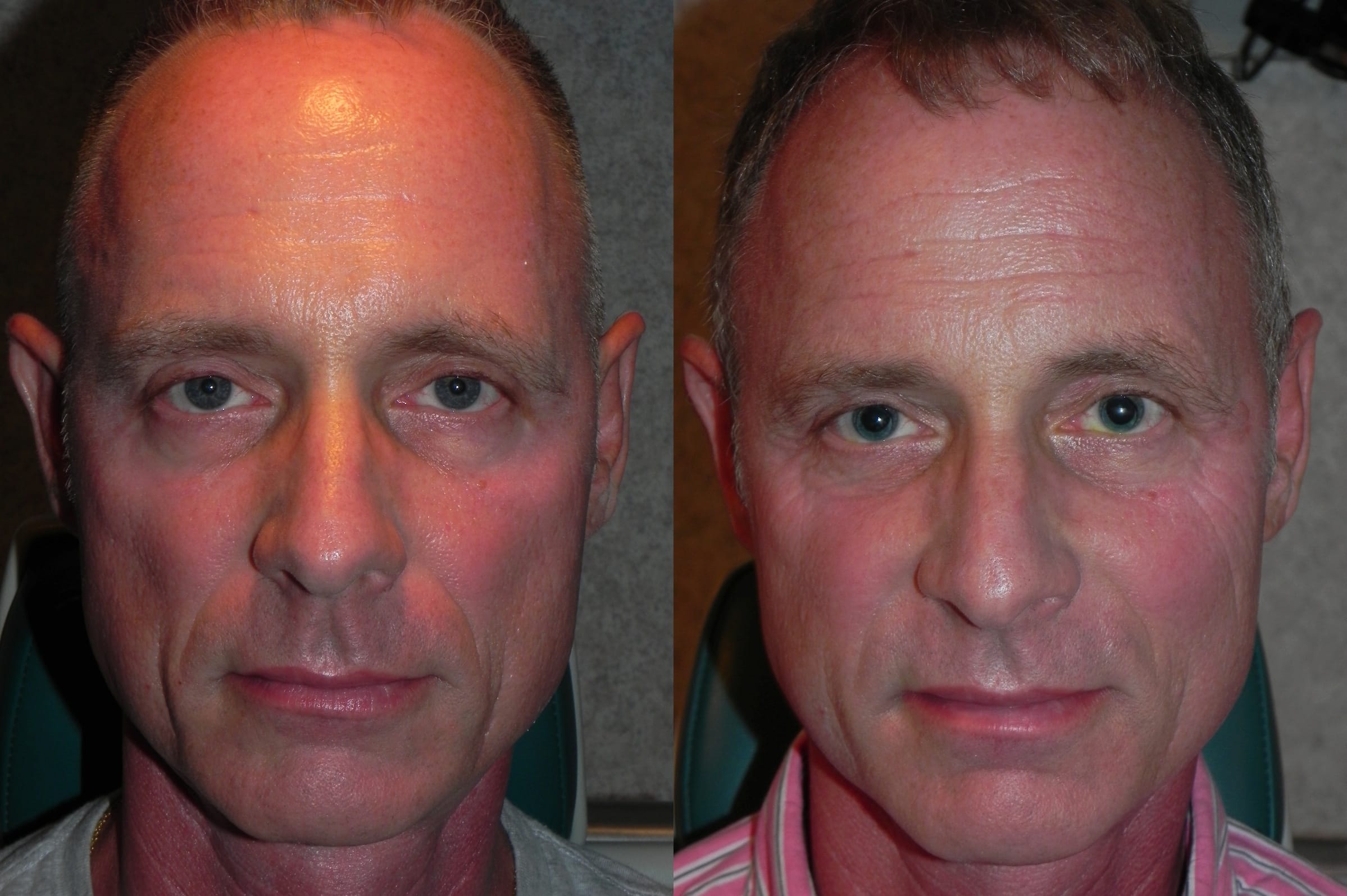 Pre and Post Sculptra