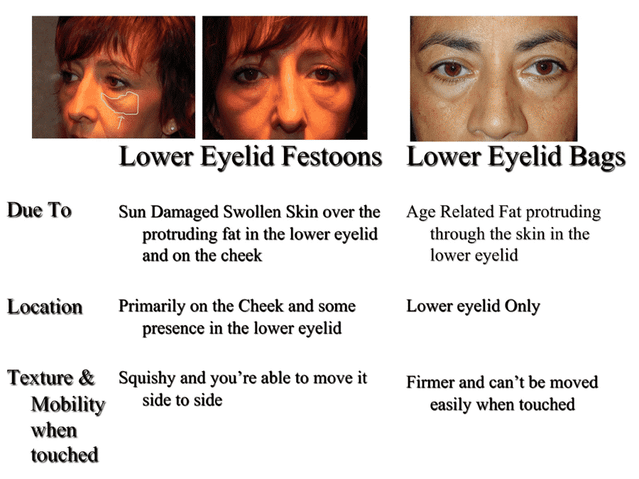 How to get rid of eye bags without the need for surgery  Mirror Online