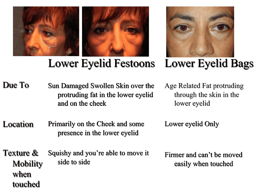 Swelling under deals eye on cheekbone