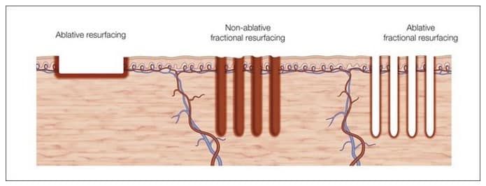 fractionated-and-non-fractionated-lasers-work