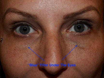 blue line after filler under eyes 