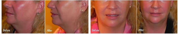 Kybella A new treatment for double/heavy chins