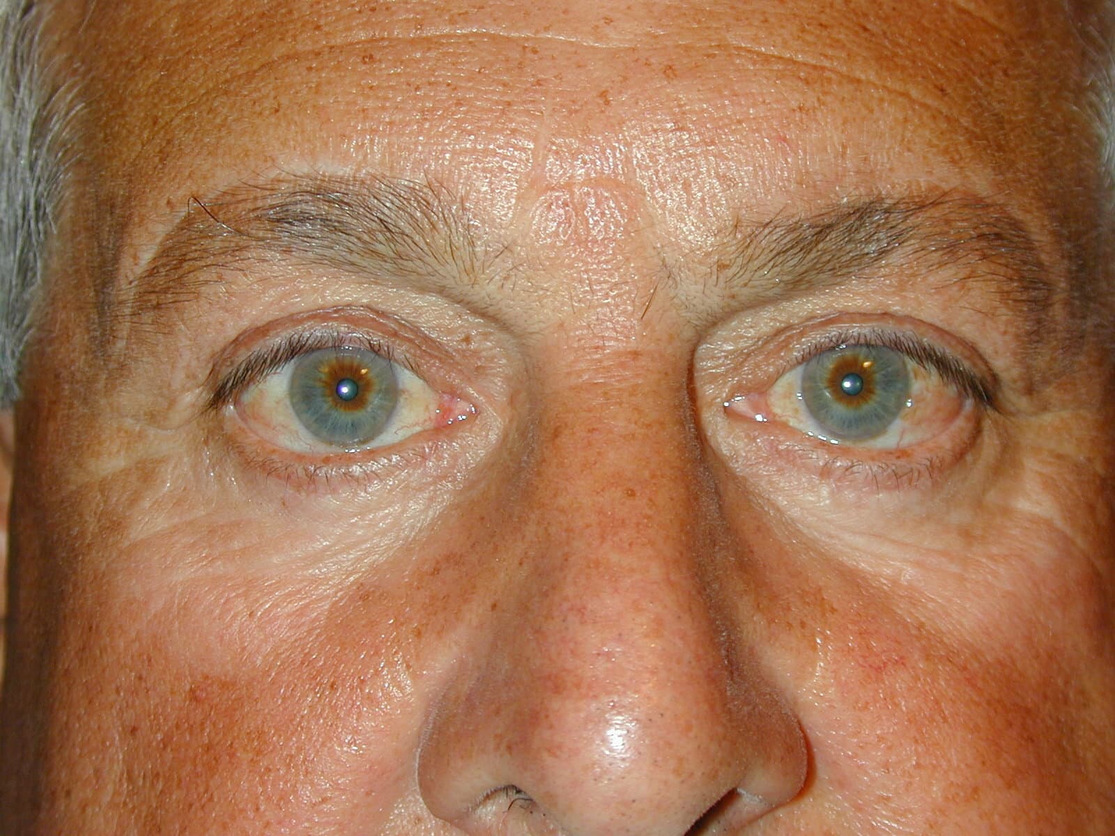 Lifting Eyebrows Causes Forehead Lines