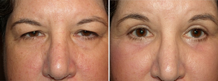 Before and After Upper and Lower Laser Eyelid Surgery with Laser Festoon Treatment