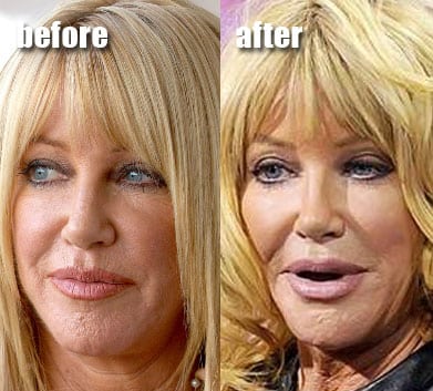 suzanne-somers-facial-fillers