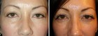 Before and After Latisse Treatment