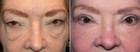 Eyelid Surgery with Laser Festoon Treatment