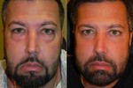 eyelid_surgery_before_and_