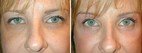 Before and After Lower Eyelid Laser Skin Resurfacing