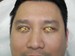 eye_protection_during_dry_eye_treatment