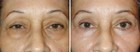 Before and After Lower Laser Eyelid Surgery with Lower Eyelid Laser Skin Resurfacing