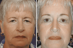 Volume loss that occurs with aging can sometimes cause the eyelids/eyebrows to become heavy. This can give the appearance of being tired (shown in the before picture on the left).
