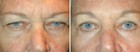 Lower Laser Eyelid Surgery with Lower Eyelid Laser Skin Resurfacing