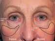 Before and after photos of the same patient, showing under-eye bags removed but Festoons (malar mounds) still present, highlighting the difference between the two