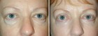 Before and After Lower Laser Eyelid Surgery with Lower Eyelid Laser Skin Resurfacing 2