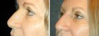 Before and After 5 Minute Injectable Nose Job