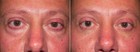 Laser Eyelid Surgery Patient 