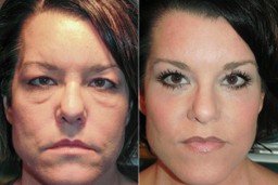 festoon eye surgery 