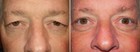 Before and After Upper Laser Eyelid Surgery 2