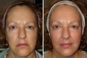 Before and After RadiantLift