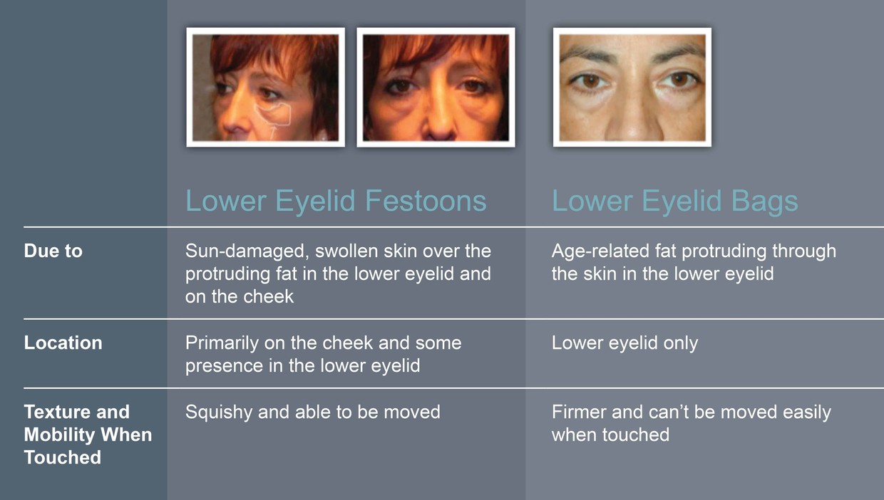 Lower Eyelid Bags vs. Festoons Adam Scheiner MD Dr. Adam Scheiner