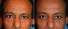 Before and After Lower Laser Eyelid Surgery