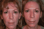 Treatments that restore lost volume in the face can reverse these aging effects.