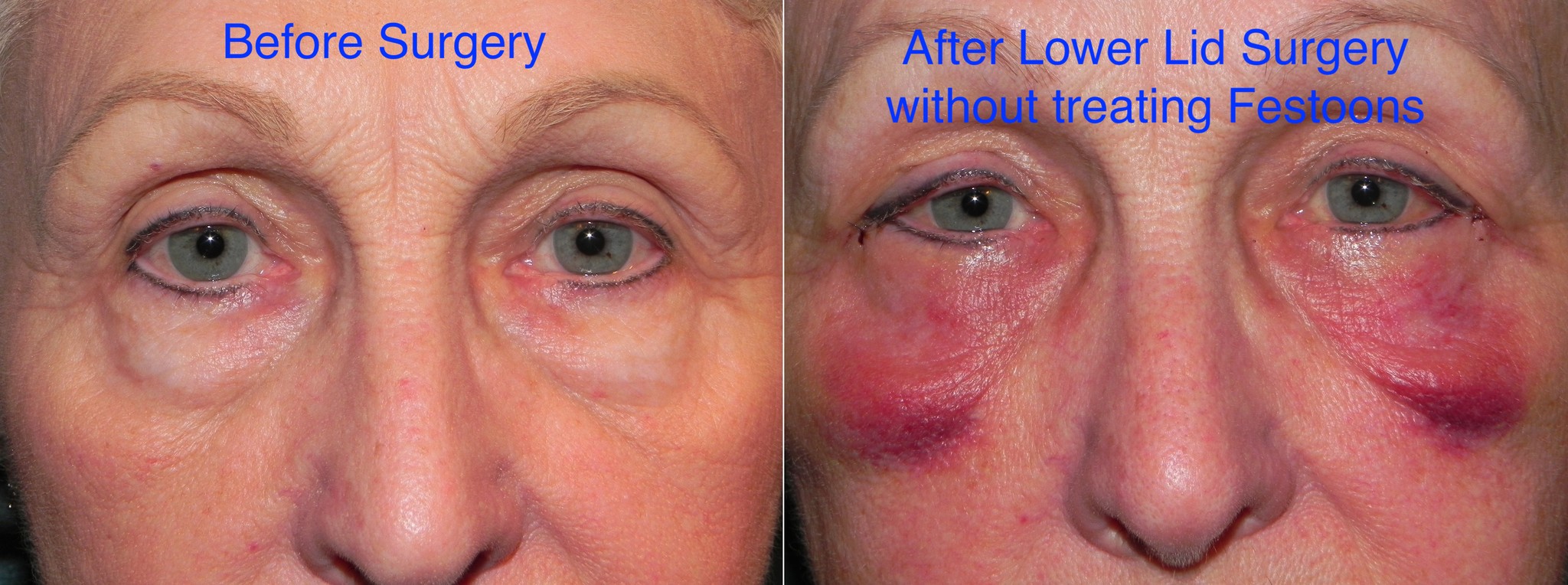 10 Things You NEED to Know About Festoons Adam Scheiner MD Dr. Adam