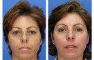 Before and After Microlaser Peel by Colleague Jason Pozner