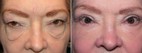 Before and After Upper and Lower Laser Eyelid Surgery with Laser Festoon Treatment