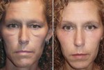 Improved lower eyelid festoons and Malar mounds