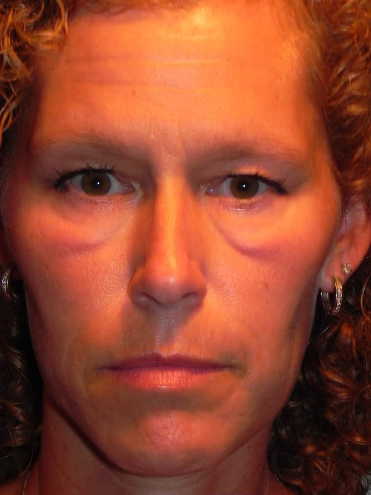 How to get rid of festoons under eyes Adam Scheiner MD Dr. Adam