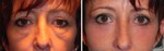 Before and after Treating lower lid fullness and Festoons