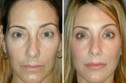 Before and After VolumaLift™
