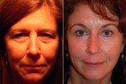 Before and After Minimal Incision Brow Lift and Lower Eyelid Surgery