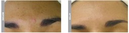 HydraFacial treatment for brown spots (before and after 4 sessions)