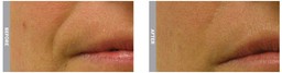 HydraFacial treatment for laugh lines (before and after 5 sessions)