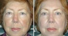 Upper and Lower Laser Eyelid Surgery
