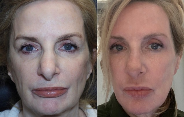 before and after blepharoplasty 