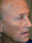 Sun exposure results in skin damage