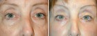 Lower Laser Eyelid Surgery with Lower Eyelid Laser Skin Resurgacing