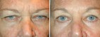 Before and After Lower Laser Eyelid Surgery with Lower Eyelid Laser Skin Resurfacing