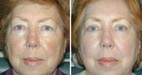 Before and After Upper and Lower Laser Eyelid Surgery with Full Face Laser Skin Resurfacing