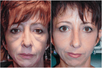 Before and after of Donna's transformation. On the left she has large bags under her eyes making her face appear old and tired. On the right the bags are gone making her eyes seem larger, more awake, and her face younger.