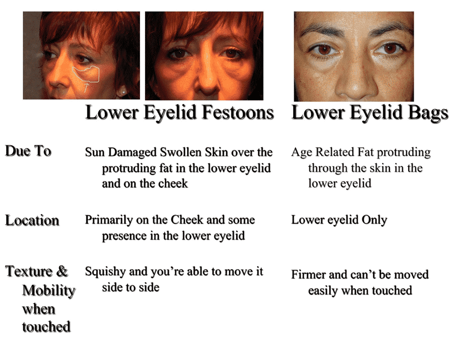 How to get rid of festoons under eyes Adam Scheiner MD Dr. Adam