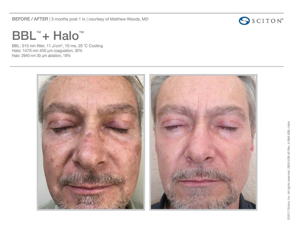 Can the HALO Laser Give You The Results You Want? – Adam Scheiner MD ...