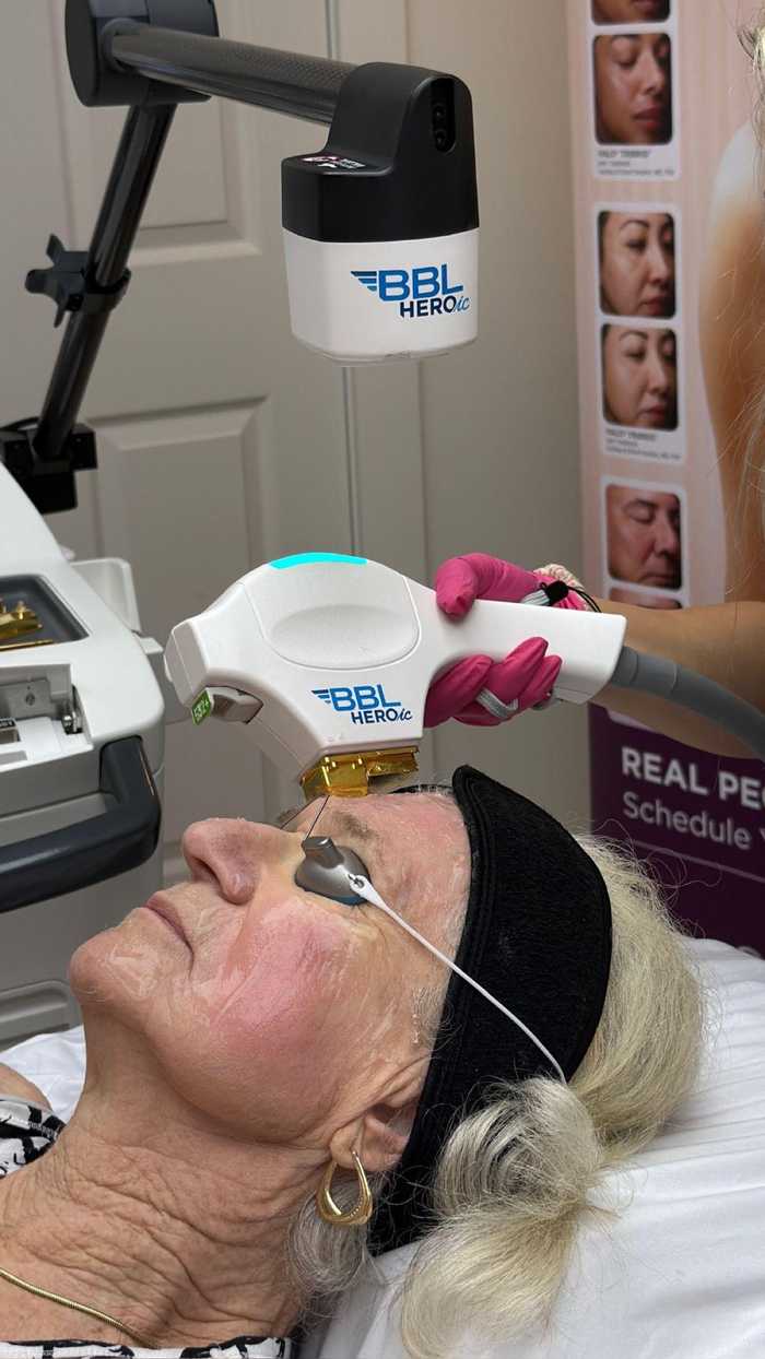 BBL HEROic® treatment
